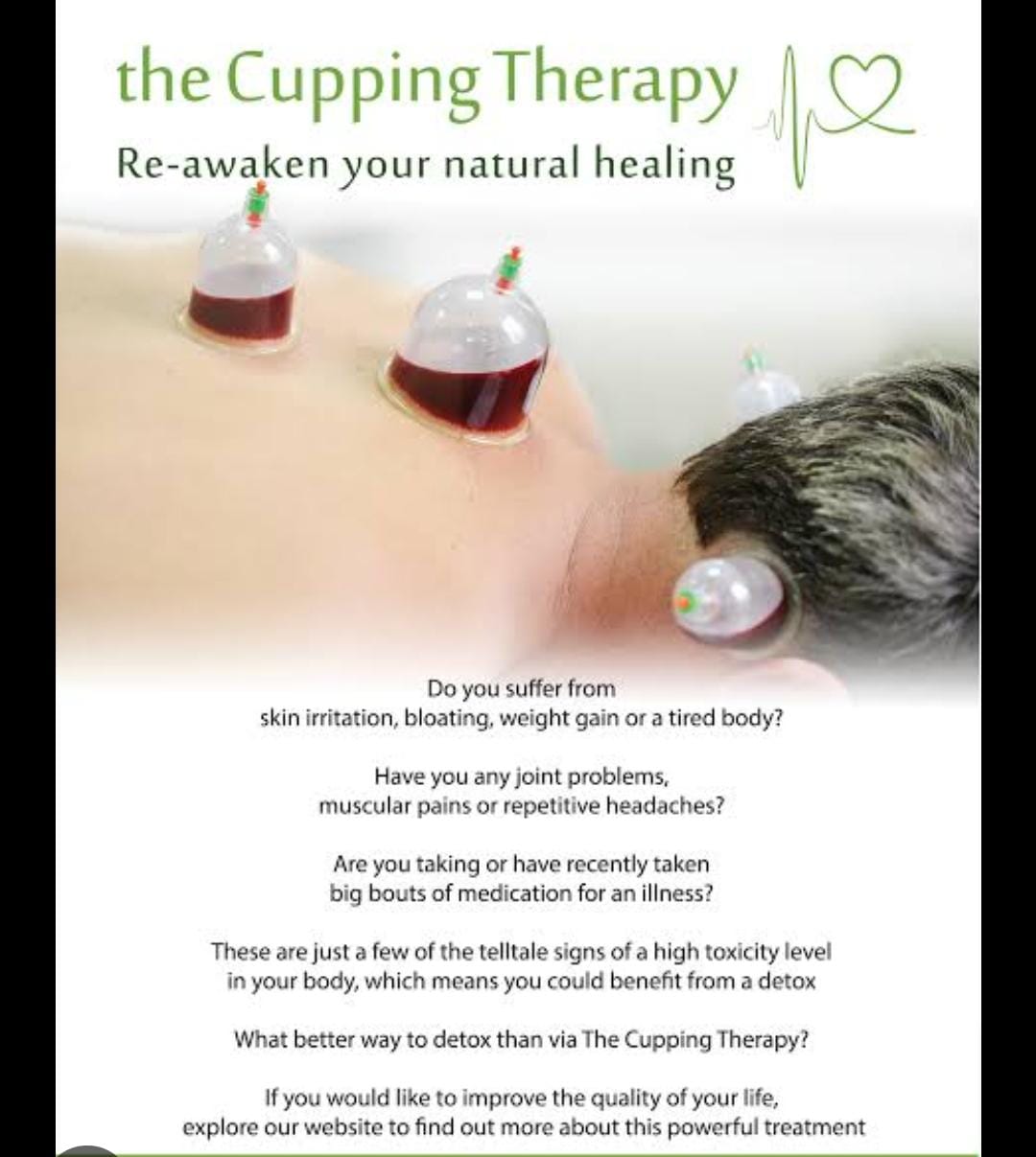 Cupping therapy 